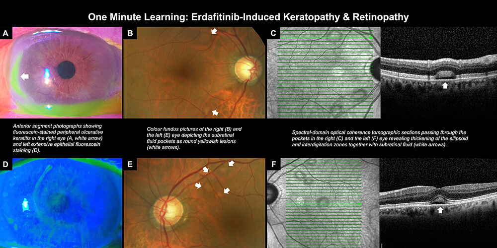 Erdafitinib-induced keratopathy and retinopathy