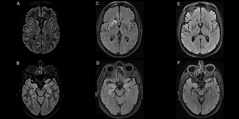 Anti-LGI1 encephalitis