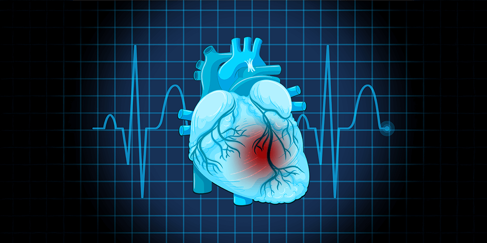Acute coronary syndromes and myocardial infarction