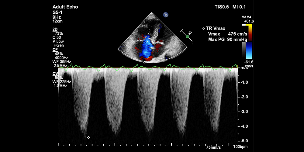 One-minute ECHO: Diagnosing severe pulmonary hypertension with a TR Jet