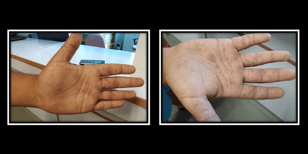 Palmar rash: A diagnostic crossroad