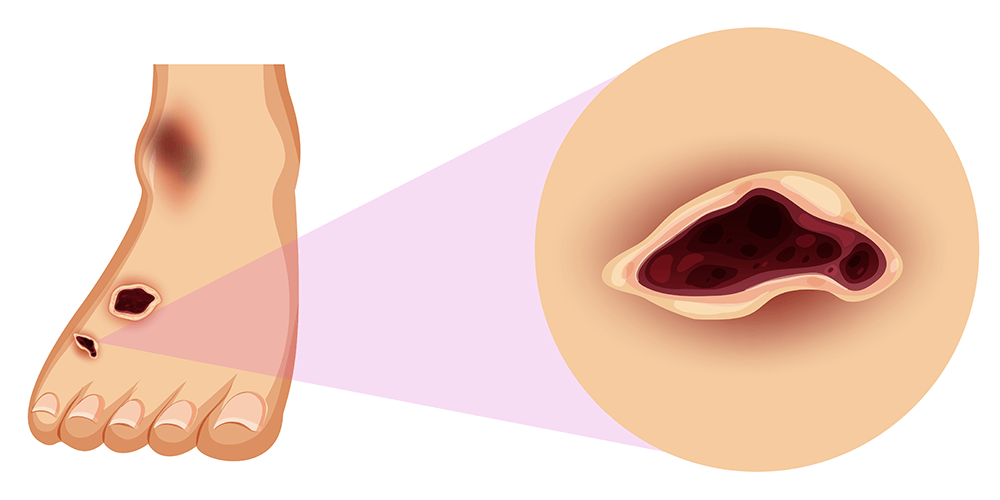 Clinical presentation, diagnosis, and management of diabetic foot disease