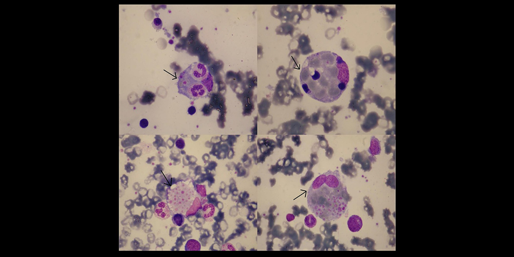 Hemophagocytic lymphohistiocytosis: A diagnostic and therapeutic emergency