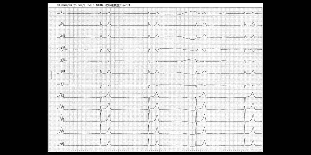 BRASH Syndrome