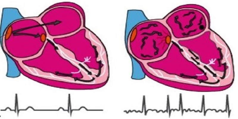 Atrial fibrillation guideline 2020