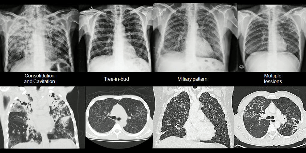 Tuberculosis 